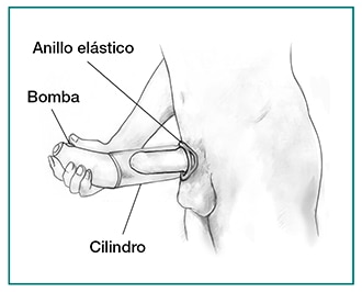 Ilustración en blanco y negro de un hombre usando un dispositivo de vacío en el pene. El aparato incluye un anillo elástico, una bomba, y un cilindro.